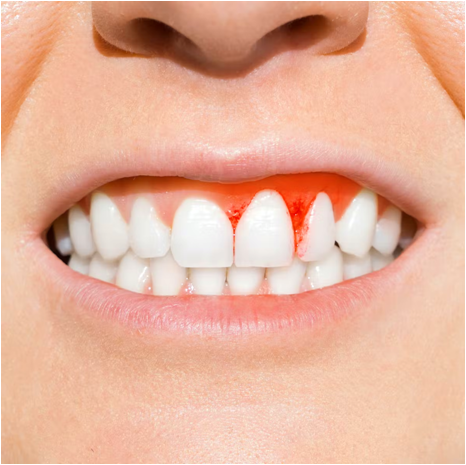 Gum Diseases